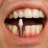 Dental Treatments