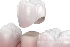 Temporary Prosthesis