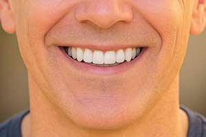 Final Smile