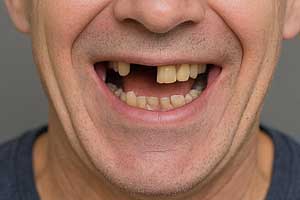 Implant Planning