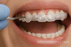 Surgical Guide Placement