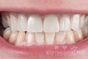 After Smile Makeover
