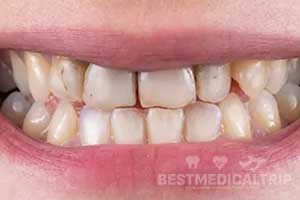 Before Veneers