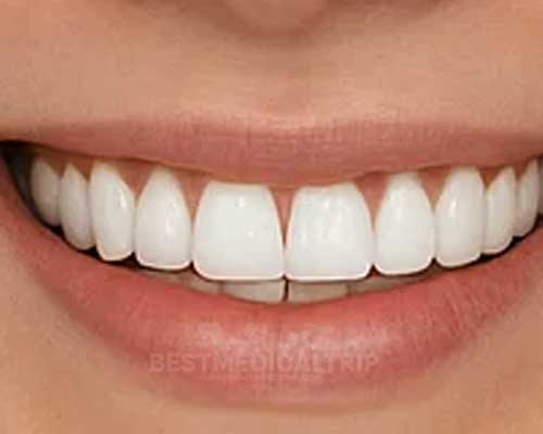 After Smile Makeover