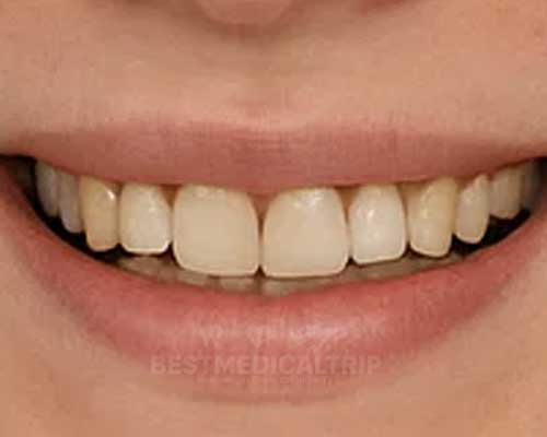 Before Smile Makeover