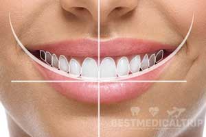 Smile Design