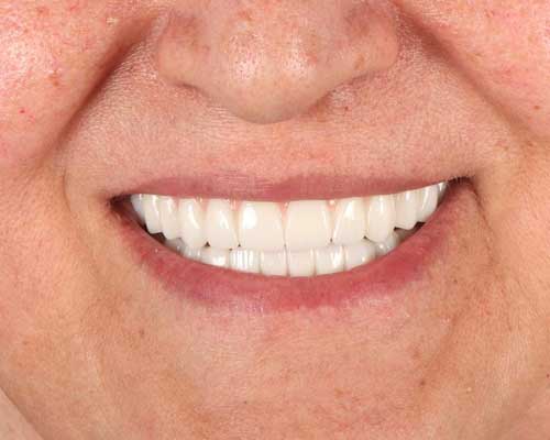 After Implant