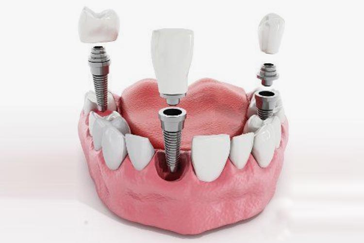 Implant Model