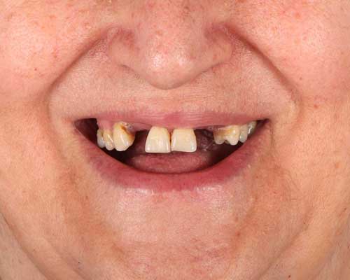 Before Implant