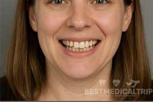 Before Whitening