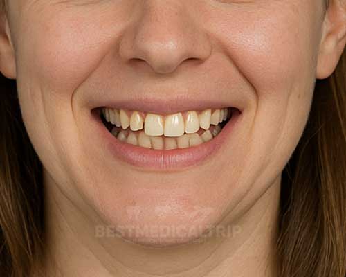 Before Whitening