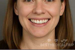 After Whitening