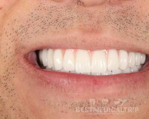 After Zirconium Crowns