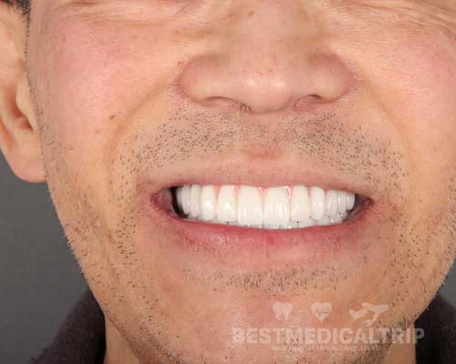Zirconium Results