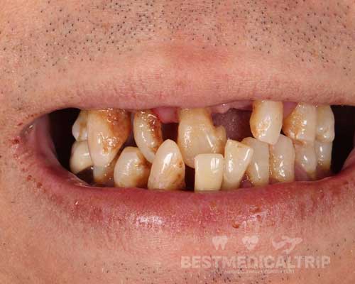 Before Zirconium Crowns
