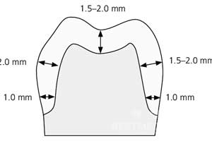 Zirconium Crown Preparation