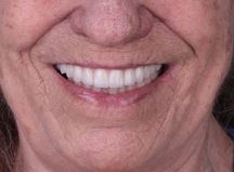 Smile with Zirconium