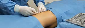 Pre-surgery preparation