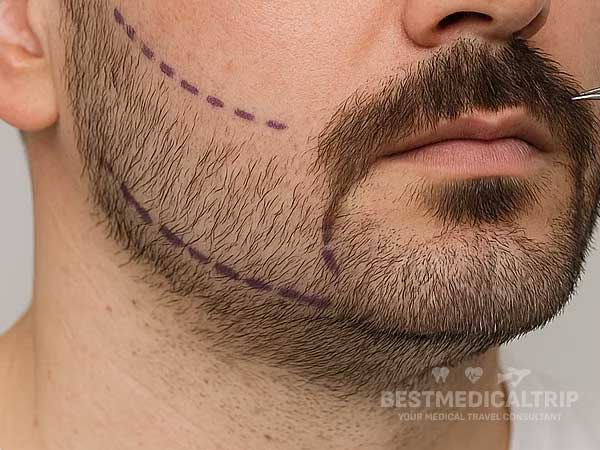 Beard Transplant Patient