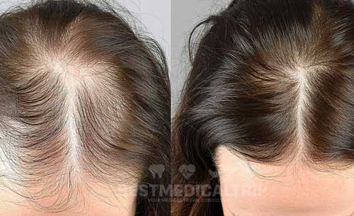 Ozone Therapy Result