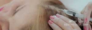 Injection to scalp