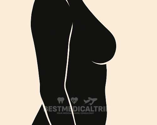 Breast Enlargement Result 1
