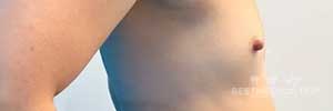 Before Surgery