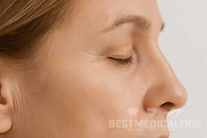 Eyelid Before
