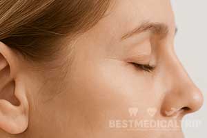 Eyelid After