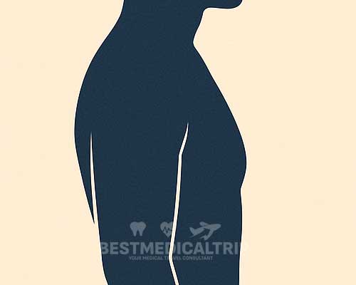 Gynecomastia Before After 2