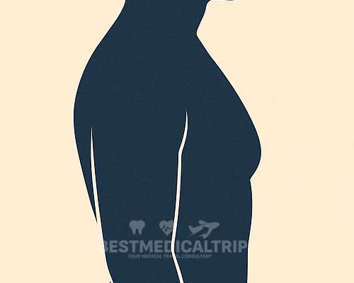 Gynecomastia Before After 1