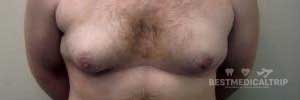 Before Surgery