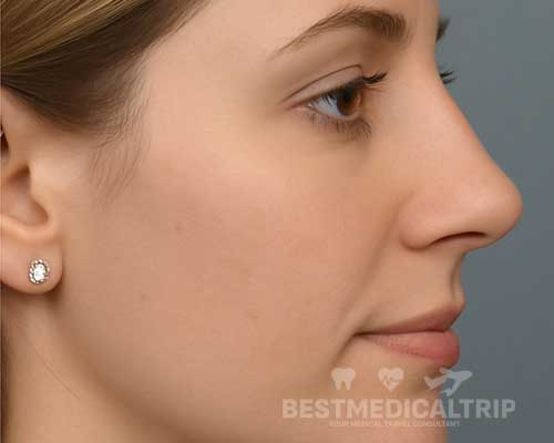 After Nose Job