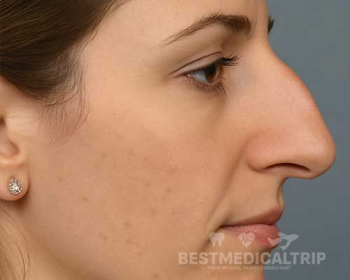 Before Nose Job