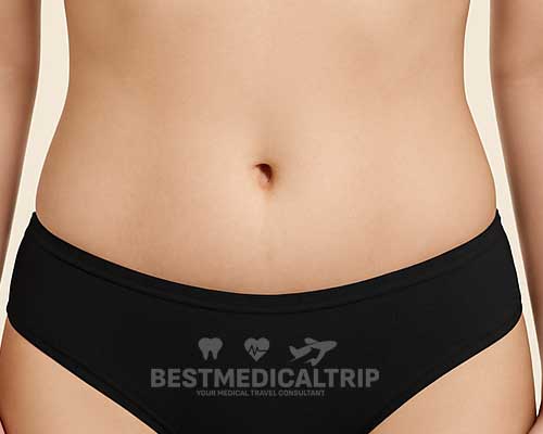 Tummy Tuck Result 2