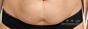 Before Surgery