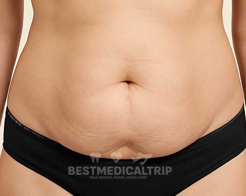 Tummy Tuck Result 1